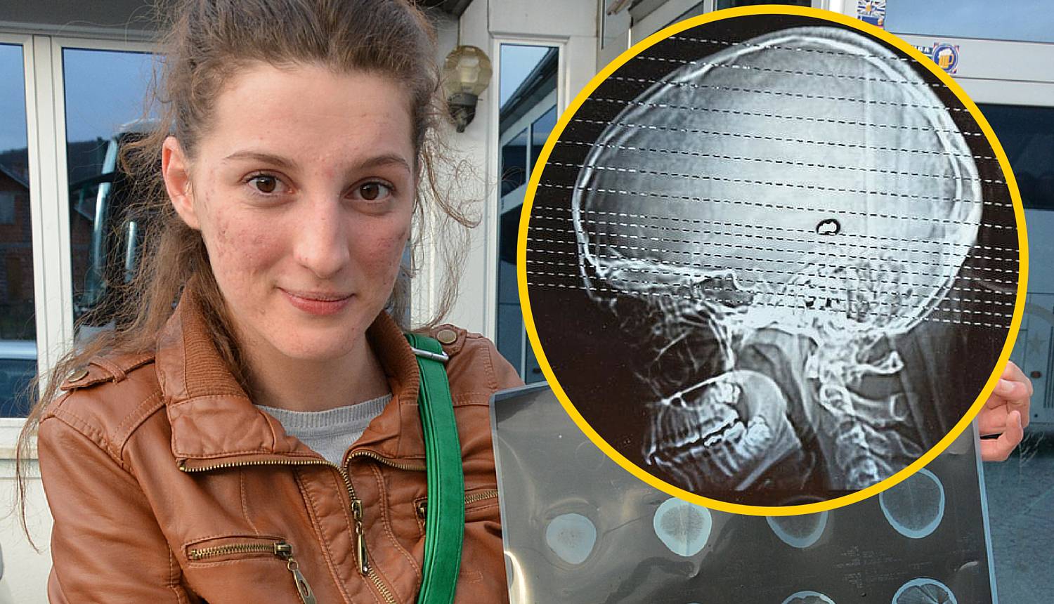 Ona živi s metkom u mozgu: 'Krv mi je tekla iz nosa i usta'