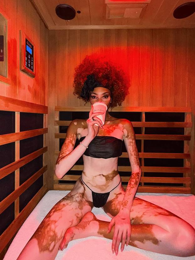 FOTO Rugali su joj se zbog bolesti, a danas je obožavaju zbog jedinstvenog izgleda