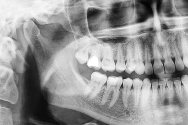 Panoramic dental x-ray of oral cavity with teeth