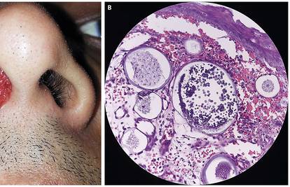 Nos mu je krvario tri mjeseca, pa su mu pronašli opasan polip