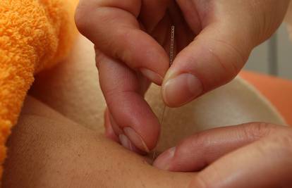 Akupunktura doista umanjuje bol, pokazalo je istraživanje