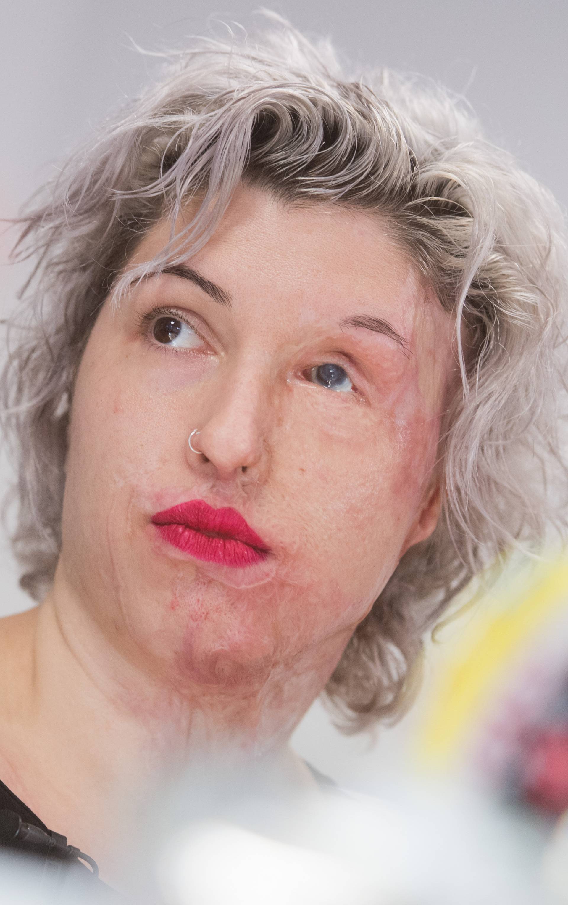 Acid victim Vanessa shows her face