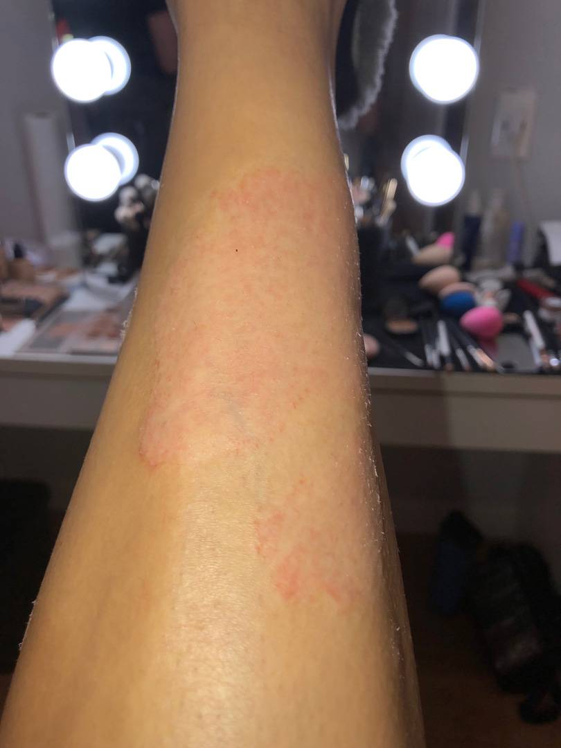 Kardashianka šokirala fanove: Pokazala kožnu bolest i na licu