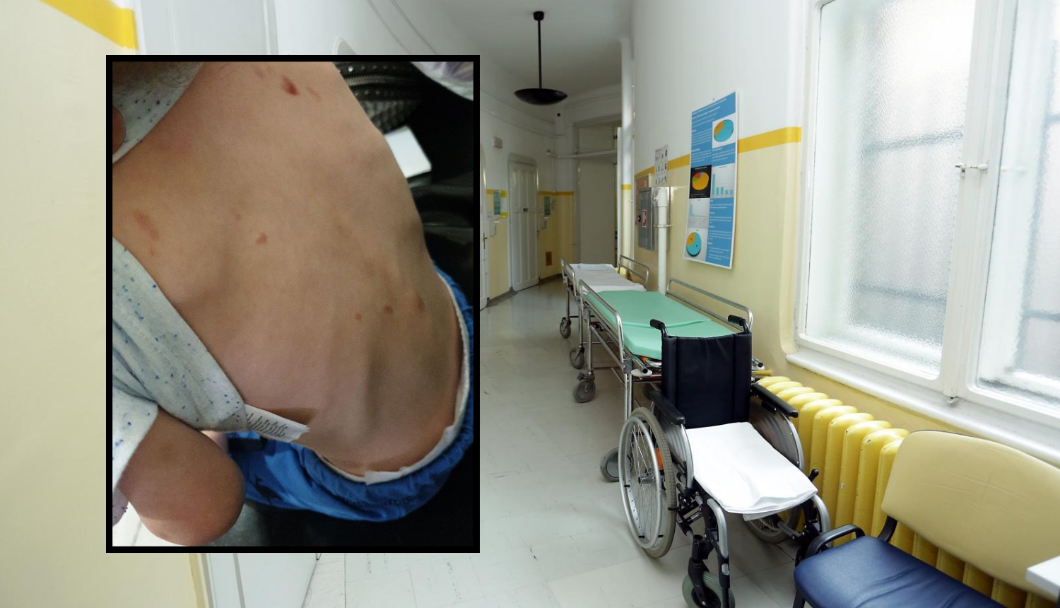 U bolnicu dovela dječaka (2) s lomovima i ožiljcima od čikova