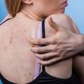 4 načina kako spriječiti pojavu akni i tamnih mrlja na leđima