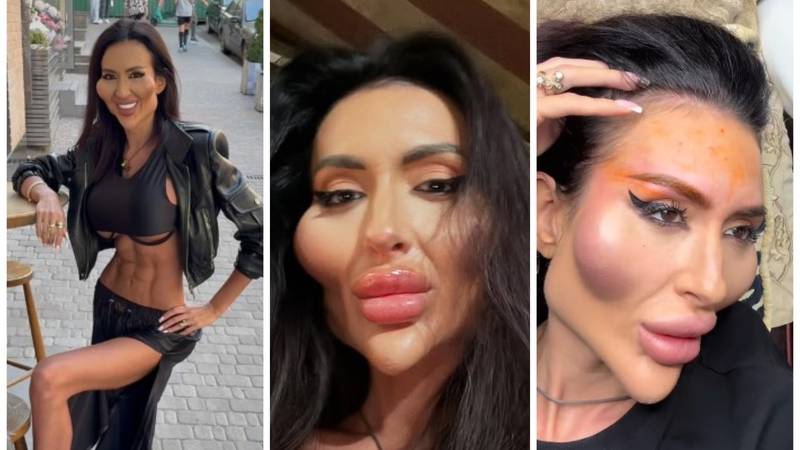 Žena s najvećim obrazima na svijetu objavila fotografiju iz mladosti: 'Šok! Šteta ljepote'