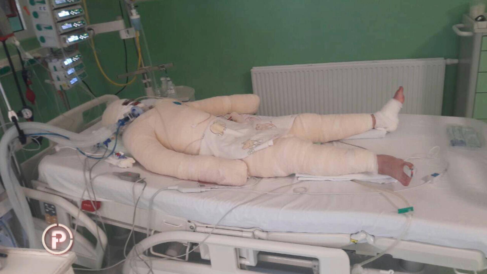 Izgorjelo mu 70% tijela: Meho je nakon operacija opet u školi