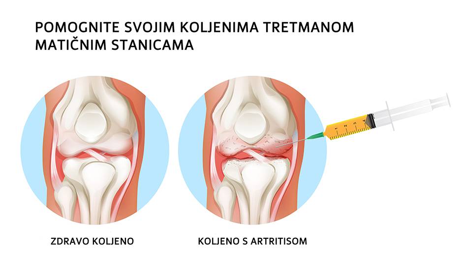 Arthritis of the human knee joint