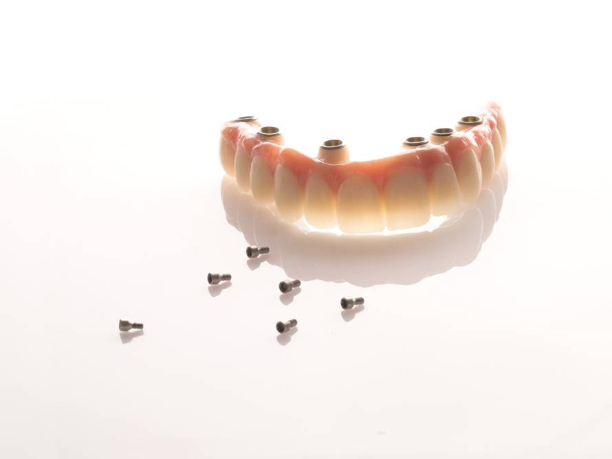 Kako dentalni implantati mogu nadomjestiti izgubljene zube