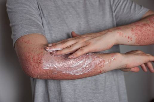 Slučaj psorijaza: 'Moja soba i crni debeli džemper postali su mi utočište i sigurnost'