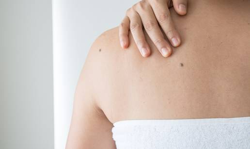 Čuvajte se Sunca: Evo što sve treba znati o najsmrtonosnijem raku kože - melanomu