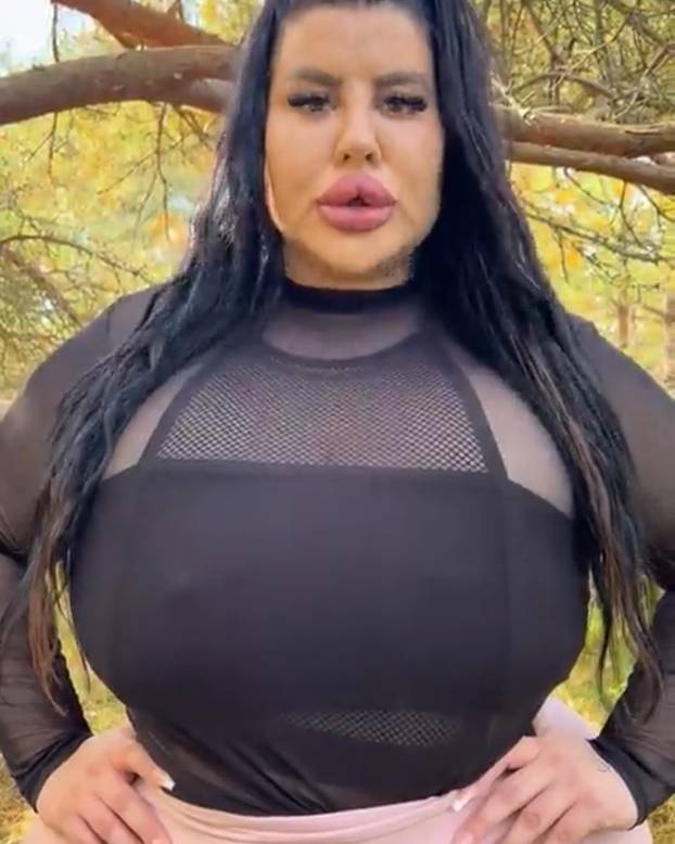 FOTO Stražnjica mi teži 45 kila, no već imam u planu sljedeću operaciju, želim imati najveću!