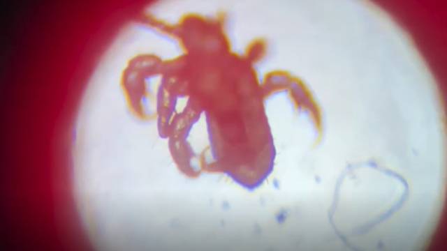 VIDEO: Pogledajte uš iz glave pod mikroskopom - evo kako se zaštititi i kako ih se riješiti