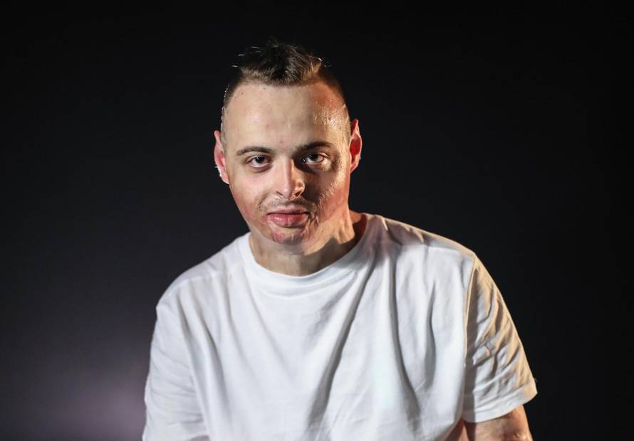 'Vatra je suknula i živ sam gorio, operirali su me sto puta'