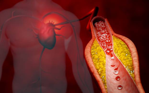 Hyperlipidemia,Or,Arteriosclerosis.,Blocked,Artery,Concept,And,Human,Blood,Vessel