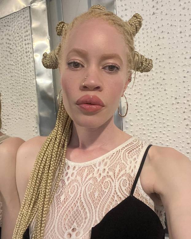 FOTO Afrikanka s albinizmom osvaja modnu industriju: 'Često privlačim znatiželjne poglede'