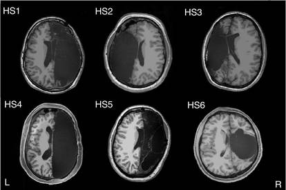 Ljudi s pola mozga: Imaju iste funkcije, mozak se prilagodio