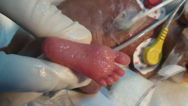 Tiniest Baby Heart Surgery