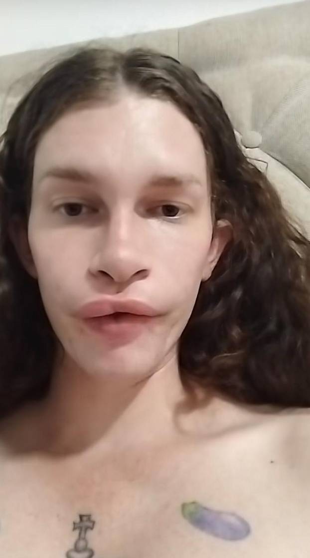 FOTO Htjela je biti žena mačka, a sad plače: Dala sam 7000 €, a fileri su me unakazili! Pomiču se