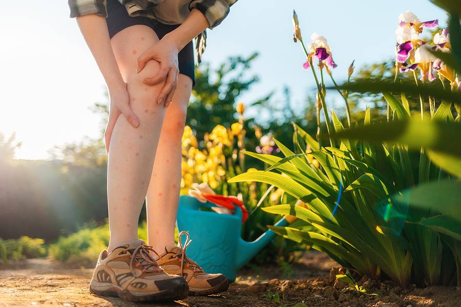 Allergies And Insect Bites Concept. Woman Scratches Her Legs, Wh