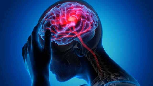 Testirajte se: Izračunajte prijeti li vam rizik od moždanog udara