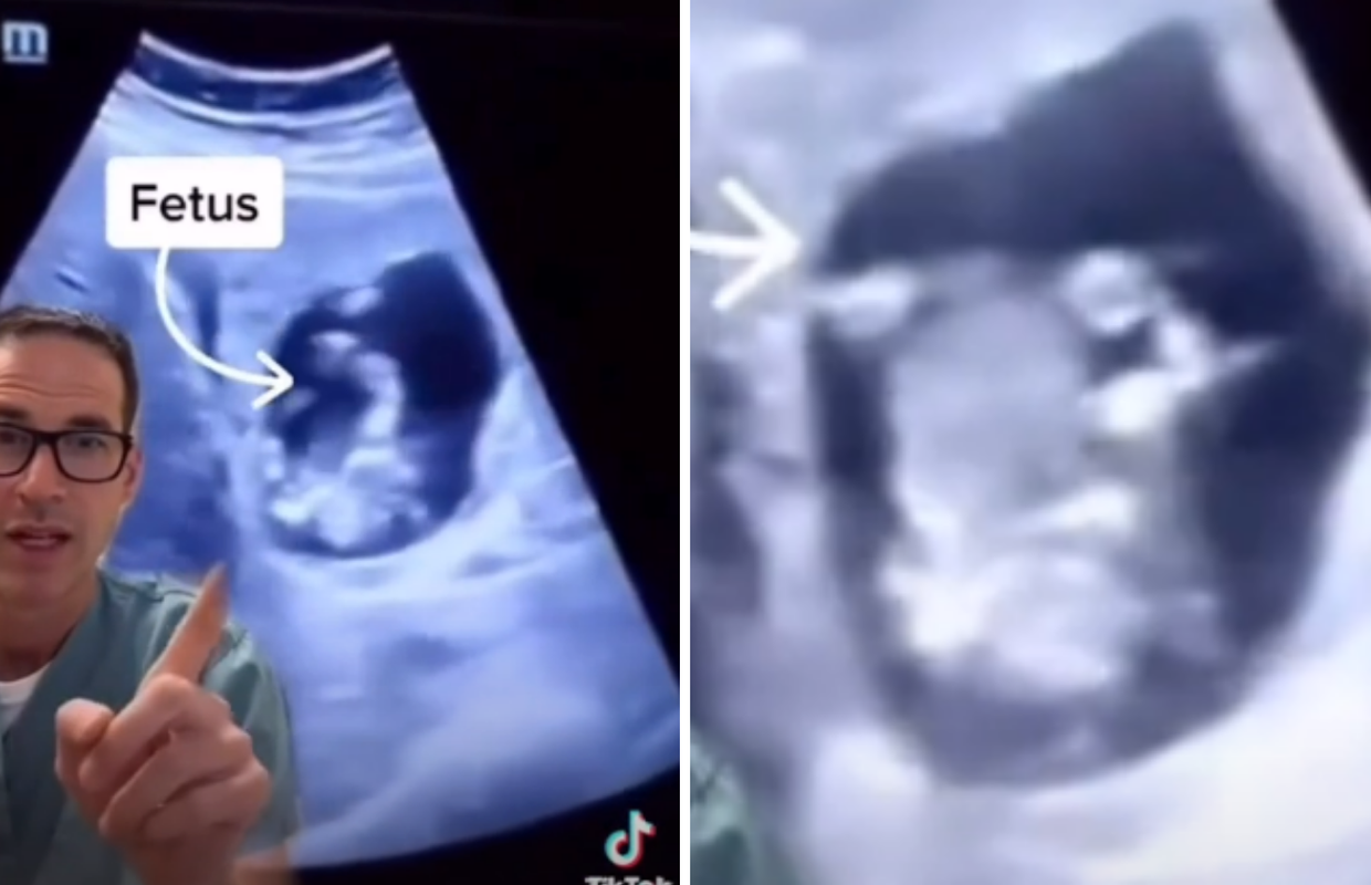 U jetri joj otkrili fetus djeteta; Doktor: 'Ovo nisam nikad vidio'