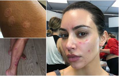 Kardashianka šokirala fanove: Pokazala kožnu bolest i na licu