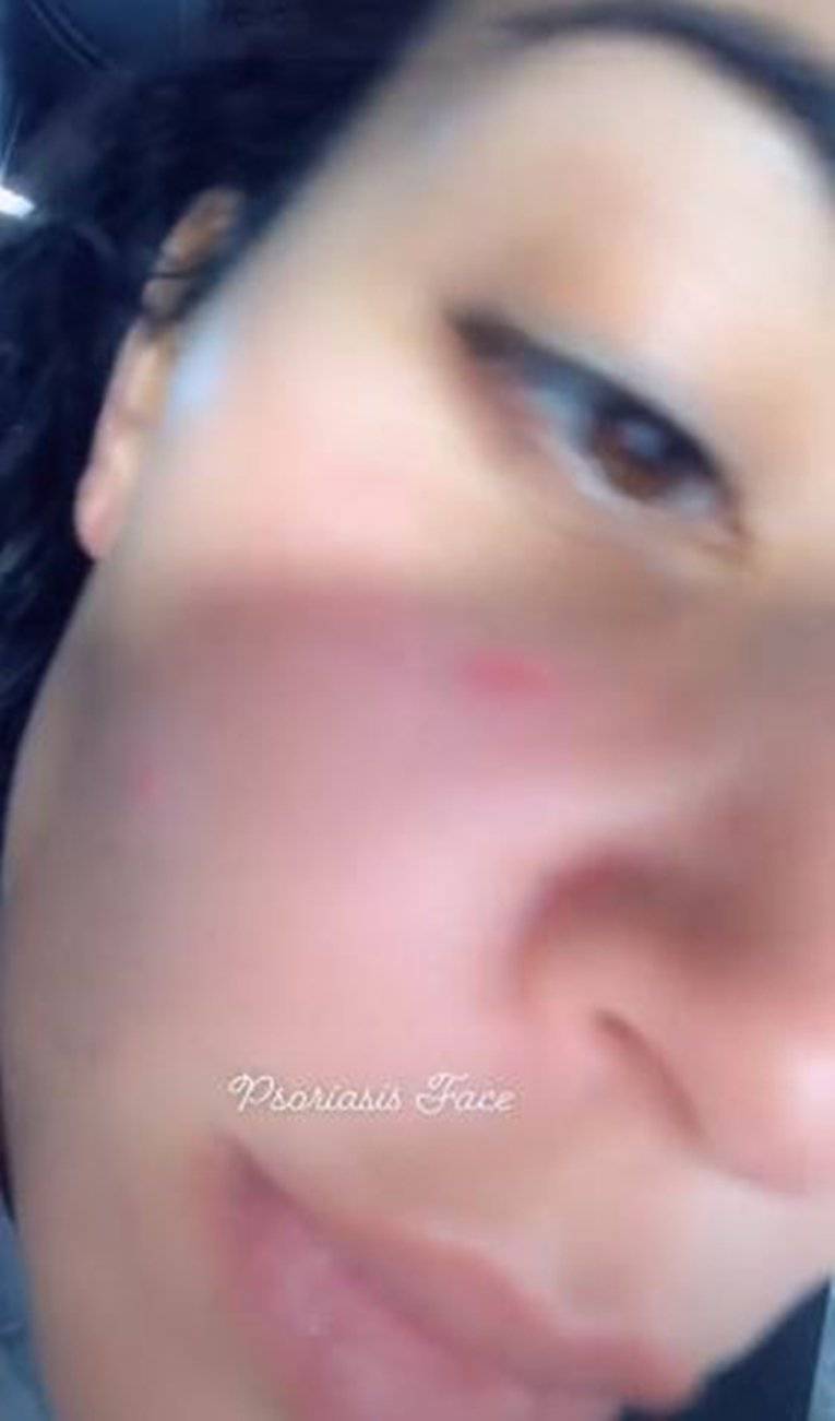 Kim pokazala lice bez šminke: 'Ovako izgleda psorijaza kože'