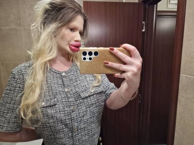 FOTO Andrea ima najveće usne na svijetu: Teško se smijem, ali ne mislim stati s operacijama...