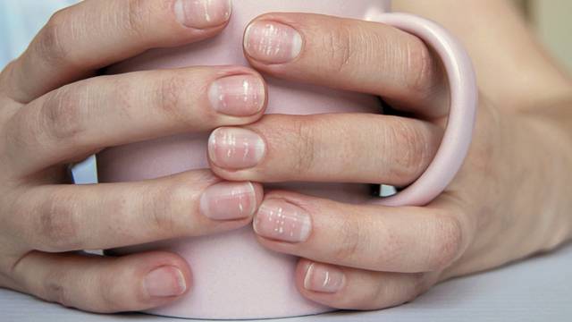 Što točno znače bijele mrlje na noktima i kako ih se riješiti?