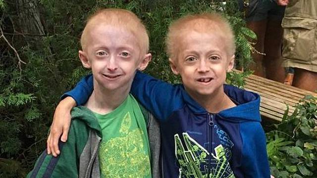 Rijetka bolest: Braća od 9 i 13 godina izgledaju poput starčića