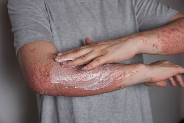 Applying moisturizer to skin with psoriasis