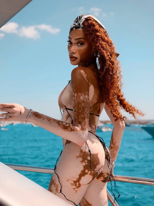 FOTO Rugali su joj se zbog bolesti, a danas je obožavaju zbog jedinstvenog izgleda