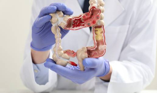 Karcinom debelog crijeva je drugi najsmrtonosniji, a mo&zcaron;e biti izlje&ccaron;iv. Sti&zcaron;e velika novost