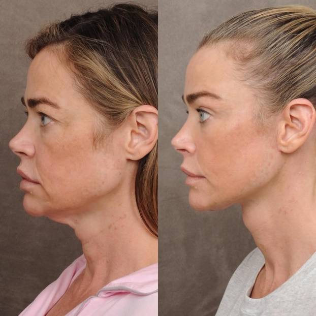 Denise Richards na faceliftingu: Sheenova bivša pokazala je fotke prije i poslije zahvata