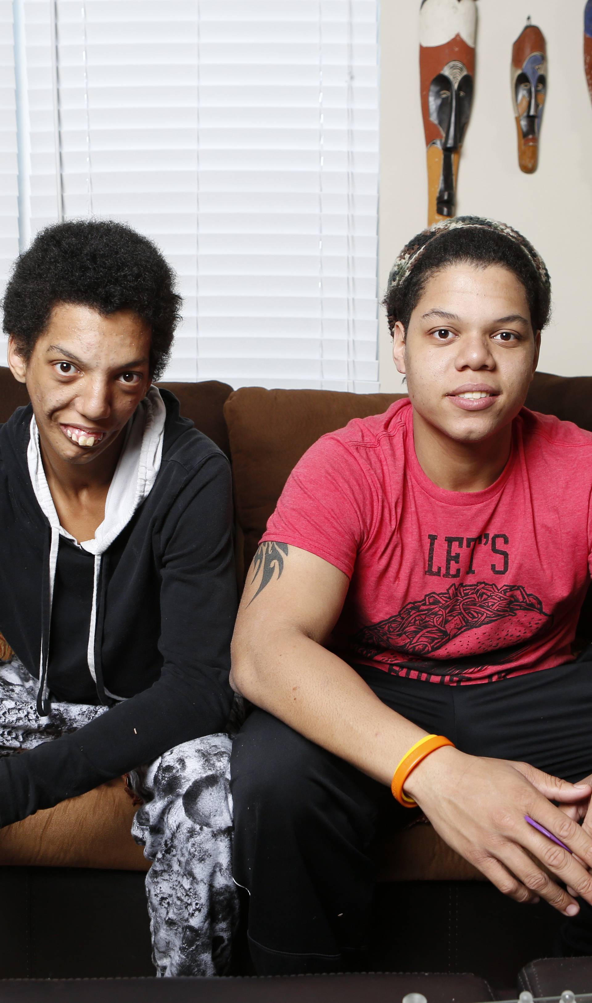 Same But Different: Identical Twinâs Rare Syndrome