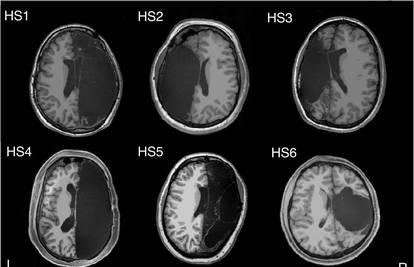 Ljudi s pola mozga: Imaju iste funkcije, mozak se prilagodio
