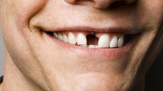 Zaboravi implantate! Uskoro će vam zubi izrasti za 9 tjedana