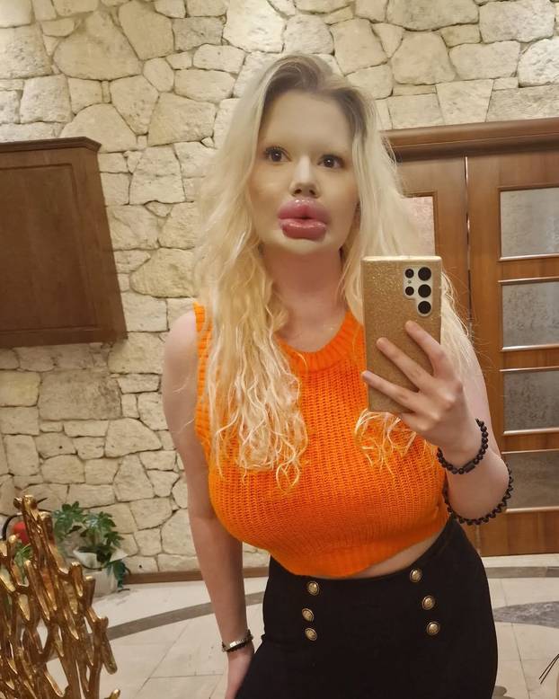 FOTO Andrea ima najveće usne na svijetu: Teško se smijem, ali ne mislim stati s operacijama...