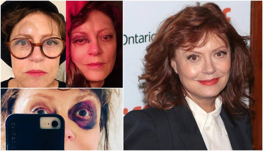 Glumica nakon potresa mozga: 'Šljiva' na oku, osmijeh na licu