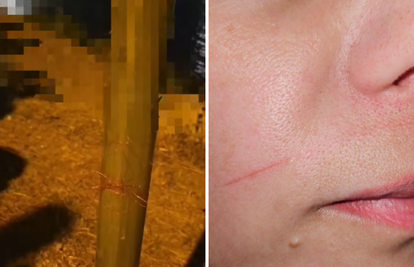 VIDEO Strava na Čiovu: 'Netko je razvukao ribolovnu nit preko ceste. Zarezala me po licu!'