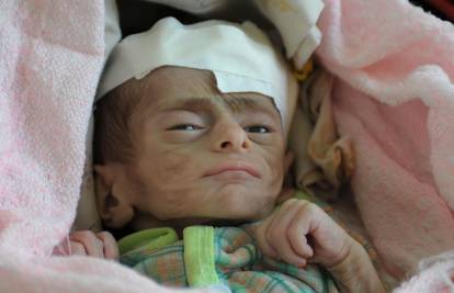 Strašne fotografije iz Jemena: Tamo djeca umiru od gladi 