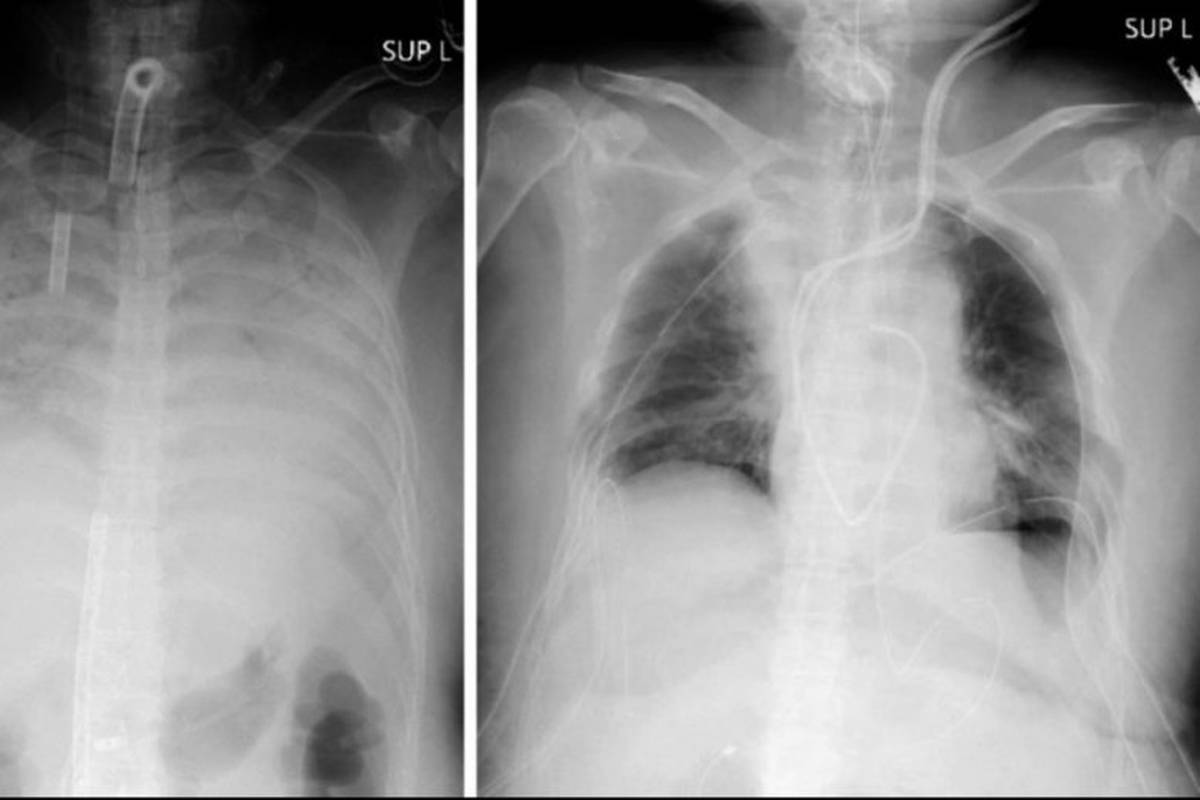 Korona joj razvalila pluća: Sin dao lijevo, suprug desno plućno krilo. Operirali su je 11 sati
