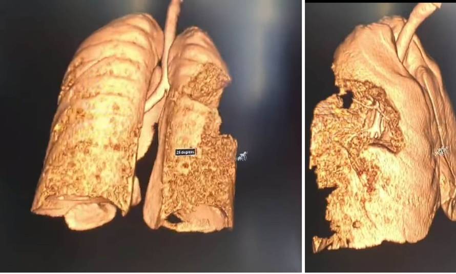 Jeziva snimka pluća oboljelog od korone: 'Ako i preživi, nikad neće moći samostalno disati'