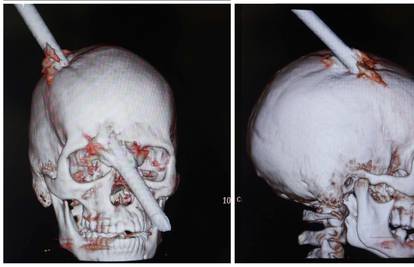 Preživio je: Gotovo dva metra duga šipka probila mu lubanju