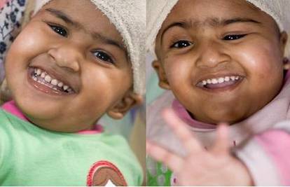Sijamske blizanke pustili iz bolnice na treći rođendan