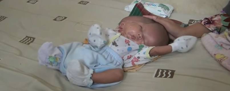 Rodila bebu s dva lica: 'Ne žele ju operirati i spasiti joj život...'