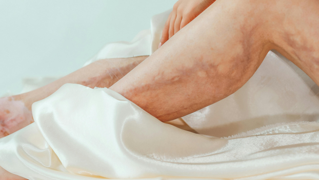 Imate proširene vene? Ovo su stvari na koje morate pripaziti