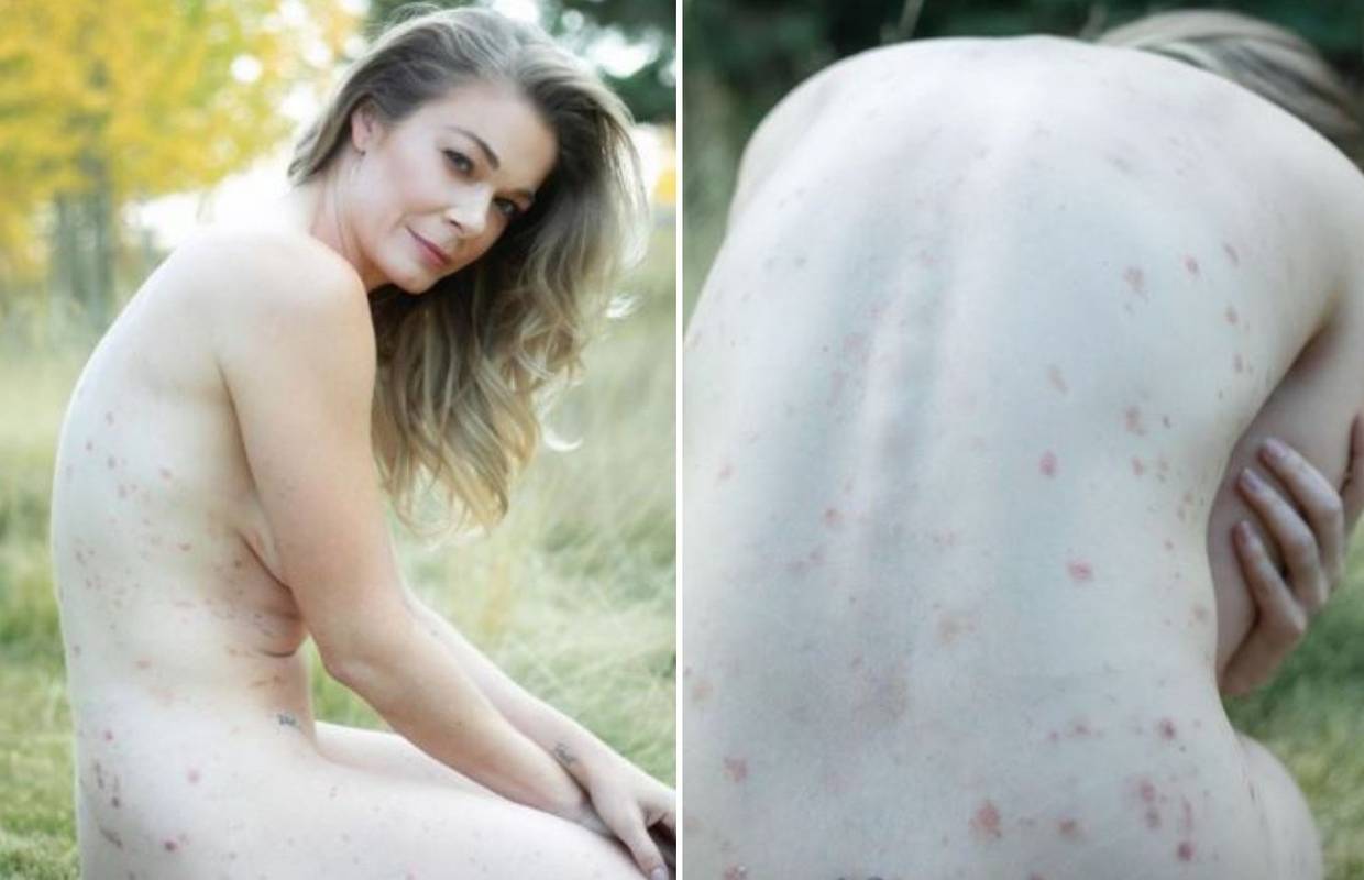 LeAnn Rimes pozirala gola i pokazala mrlje od psorijaze: Ovo mi je očajnički trebalo