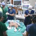 VIDEO Čudo u Peruu, doktori su razdvojili sijamske blizance: Imali su zajednički trbuh i jetru